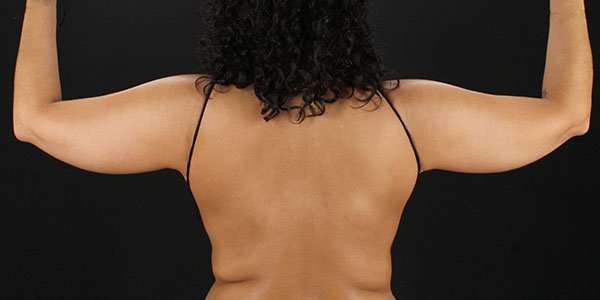 Liposuction Before & After Patient #1482