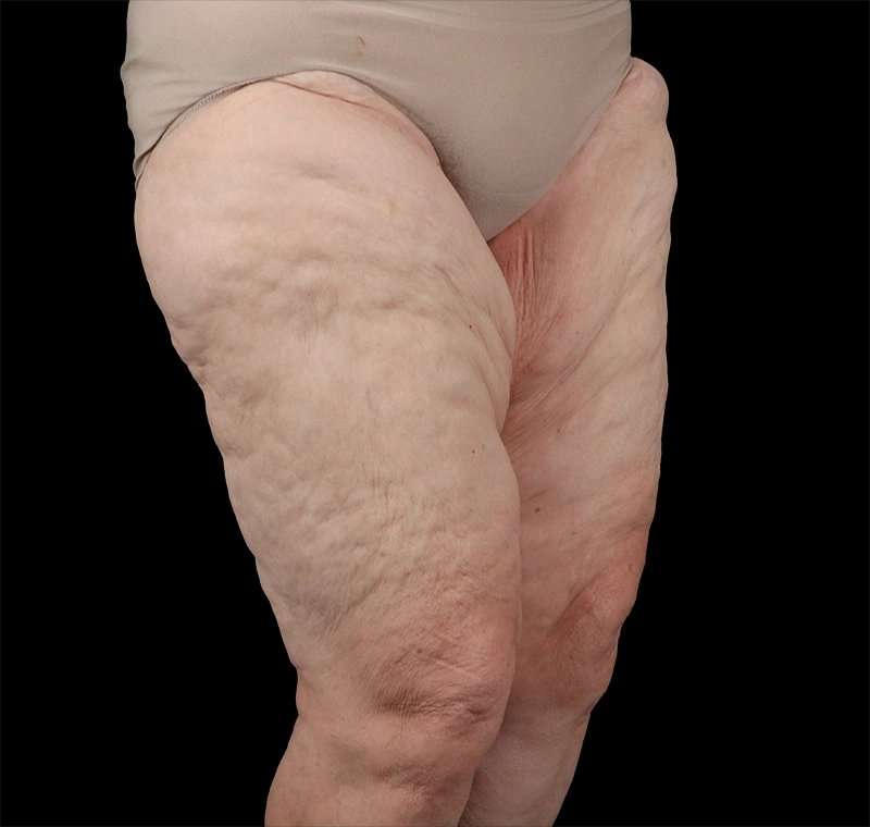 Liposuction Before & After Patient #1495