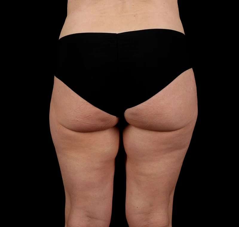 Liposuction Before & After Patient #1500