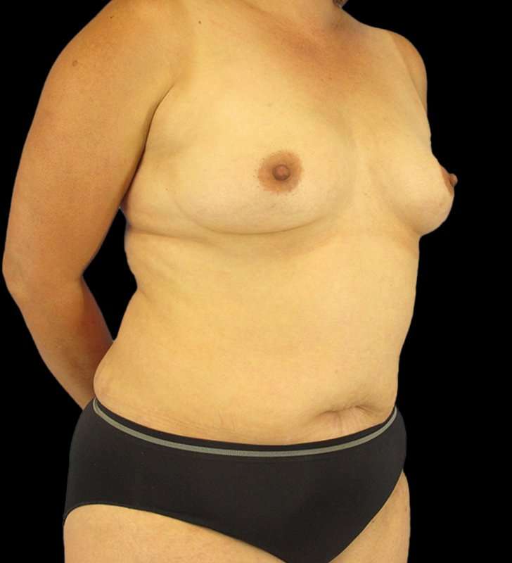 Mommy Makeover Before & After Patient #1547