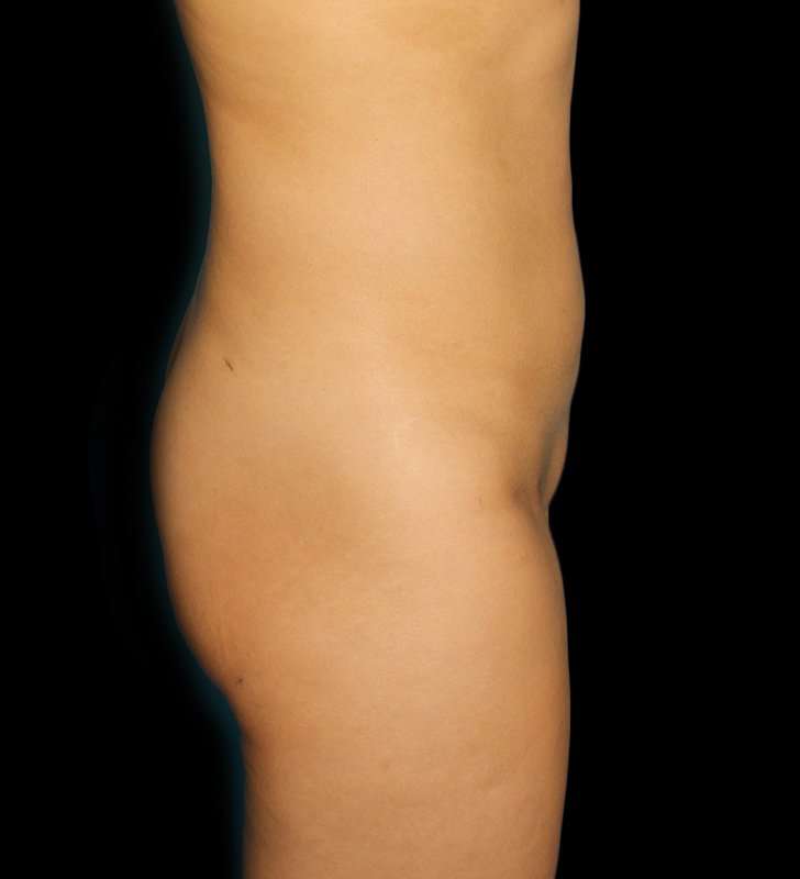 Brazilian Butt Lift Before & After Patient #557