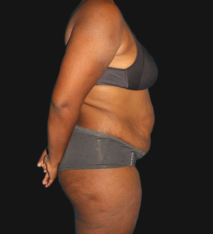 Abdominoplasty (Tummy Tuck) Before & After Patient #568