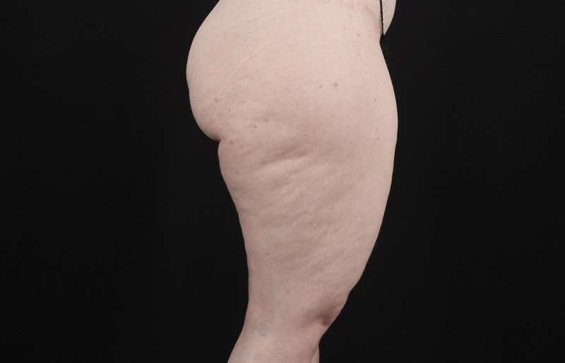Thigh Lift Before & After Patient #1925