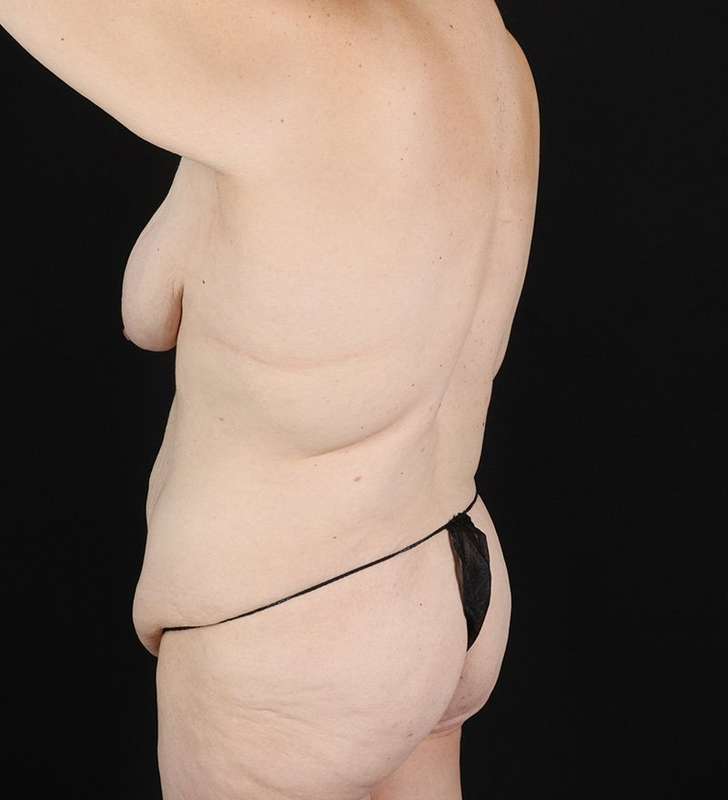 Back Lift/Tuck Before & After Patient #1939