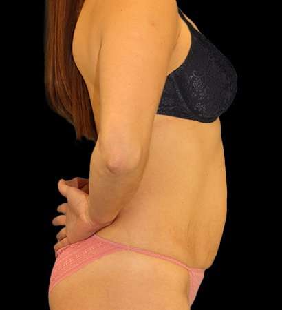 Umbilicoplasty Before & After Patient #1950