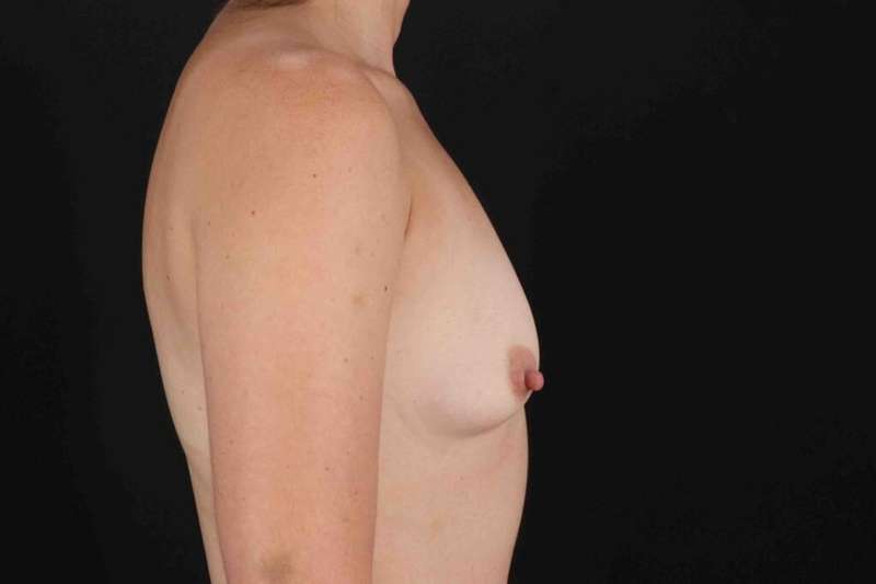 Breast Augmentation w/ Fat Transfer Before & After Patient #2027