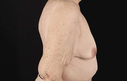 Breast Augmentation w/ Fat Transfer Before & After Patient #2049