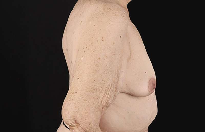 Breast Augmentation w/ Fat Transfer Before & After Patient #2049