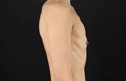 Breast Augmentation Before & After Patient #2110