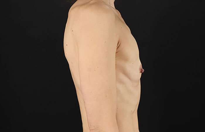 Breast Augmentation Before & After Patient #2110