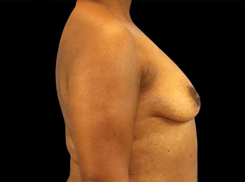 Breast Augmentation Before & After Patient #2121