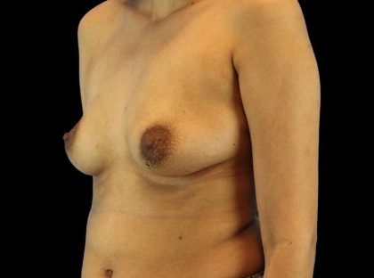 Breast Augmentation Before & After Patient #2129