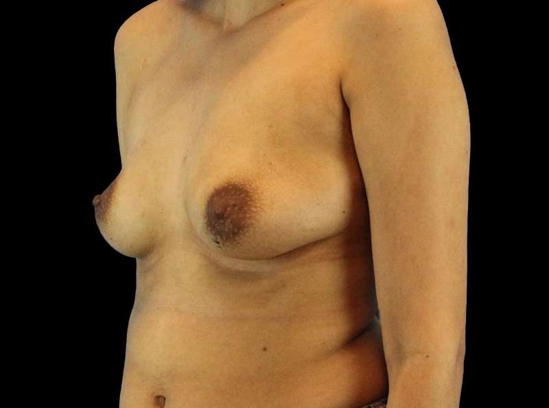 Breast Augmentation Before & After Patient #2129
