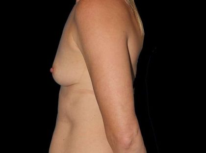 Breast Augmentation Before & After Patient #2136