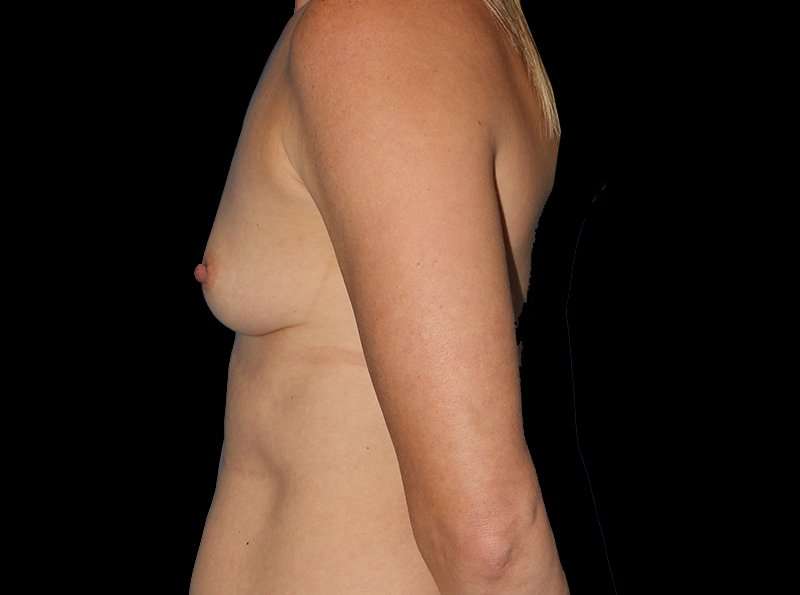 Breast Augmentation Before & After Patient #2136