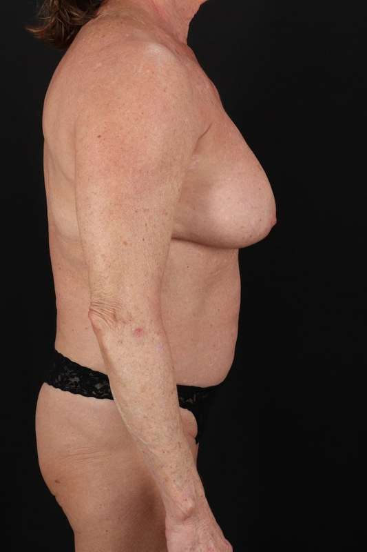 Breast Augmentation Before & After Patient #2270