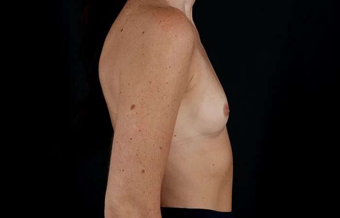 Breast Augmentation Before & After Patient #2365
