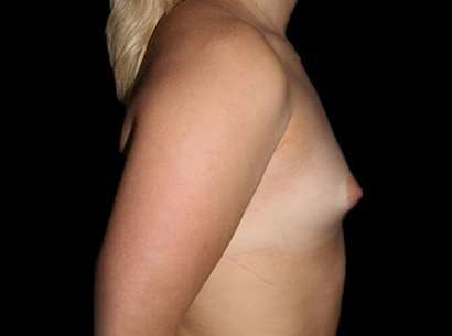Breast Augmentation Before & After Patient #2403
