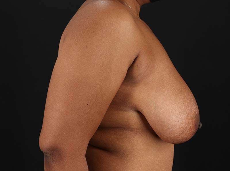 Breast Reduction Before & After Patient #2452