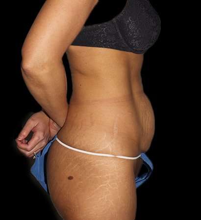 Abdominoplasty (Tummy Tuck) Before & After Patient #757