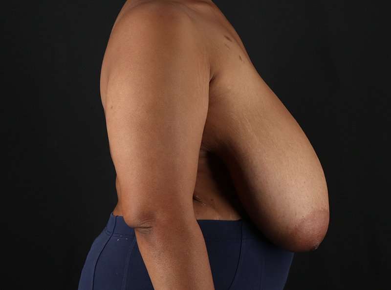 Breast Reduction Before & After Patient #2463