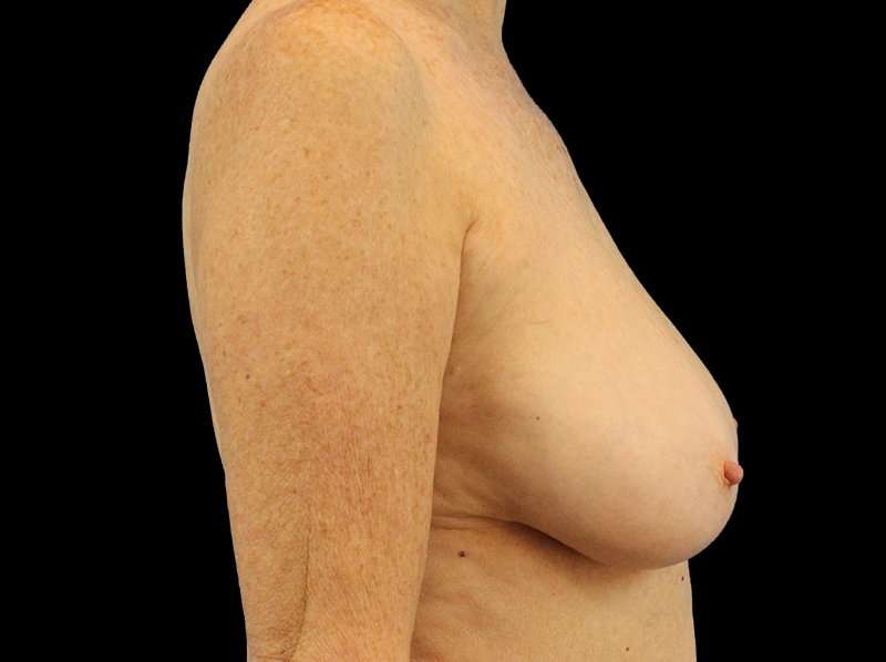 Breast Reduction Before & After Patient #2474