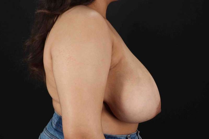 Breast Reduction Before & After Patient #2498