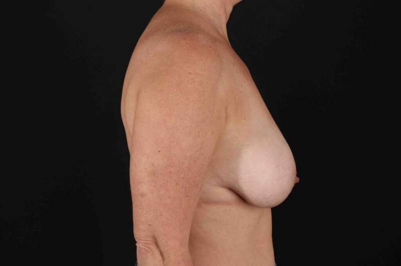 Breast Reduction Before & After Patient #2569