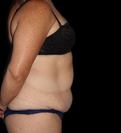 Abdominoplasty (Tummy Tuck) Before & After Patient #768