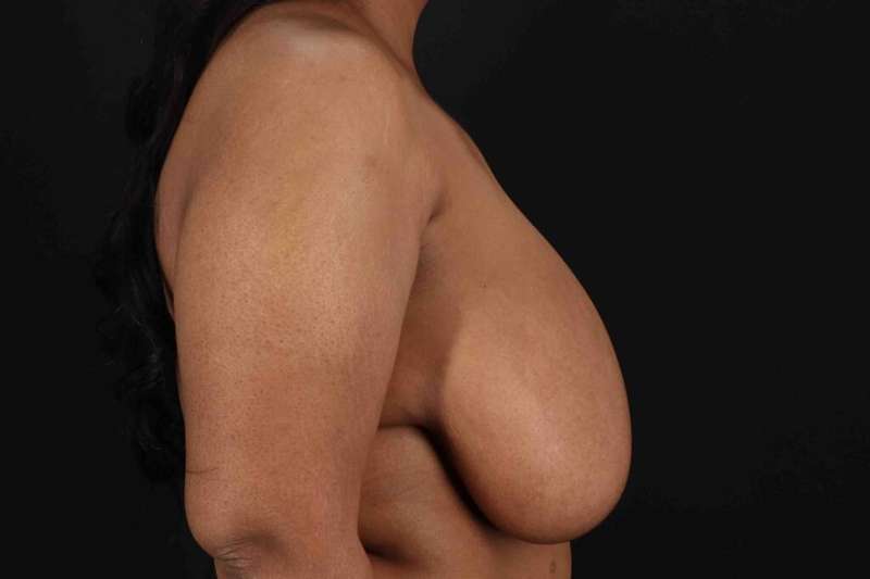 Breast Reduction Before & After Patient #2580