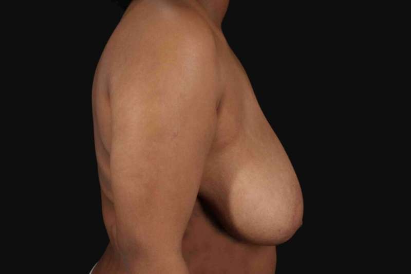 Breast Reduction Before & After Patient #2602