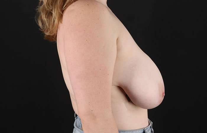 Breast Reduction Before & After Patient #2624