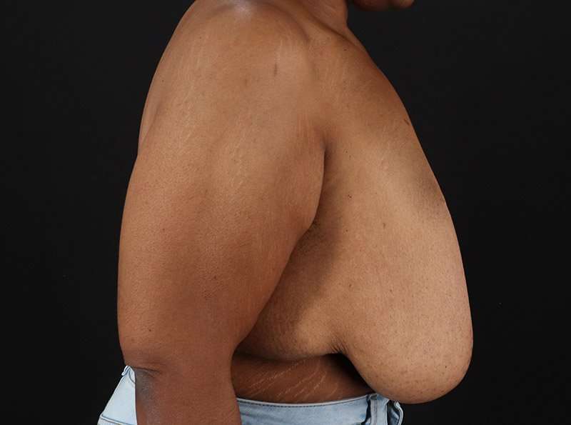 Breast Reduction Before & After Patient #2646
