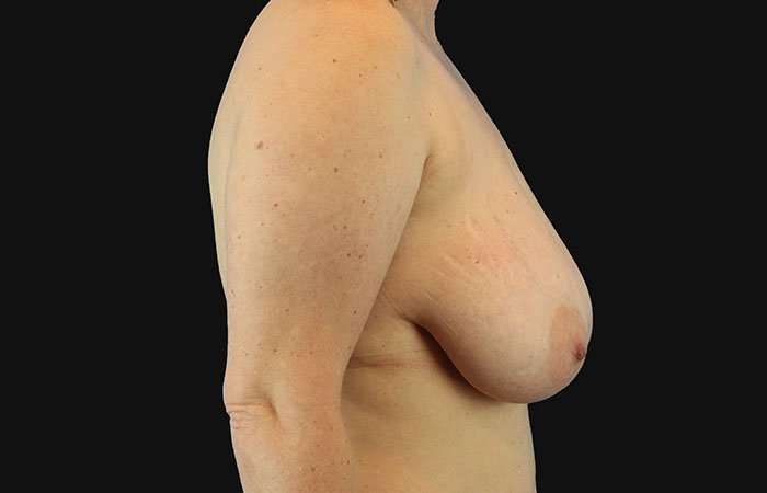 Breast Reduction Before & After Patient #2664