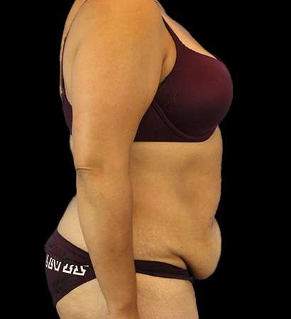 Abdominoplasty (Tummy Tuck) Before & After Patient #779