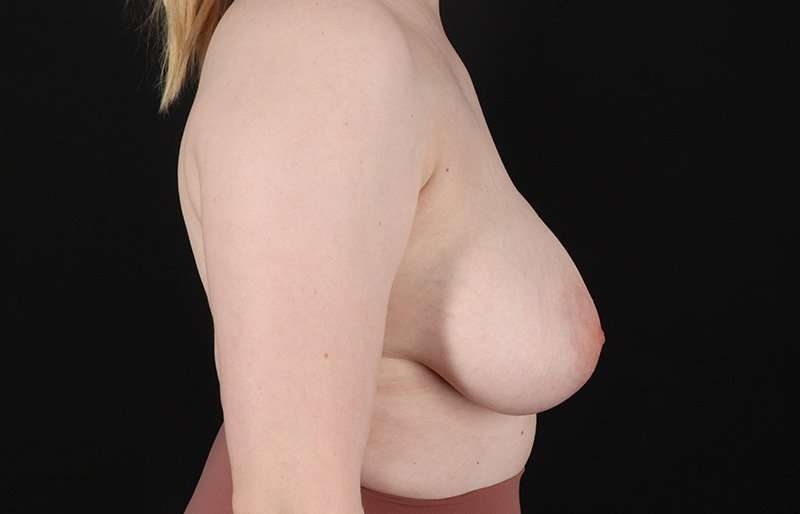 Breast Reduction Before & After Patient #2687