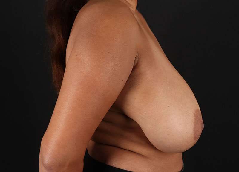 Breast Reduction Before & After Patient #2718