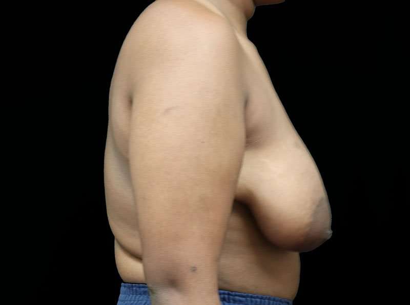 Breast Reduction Before & After Patient #2729
