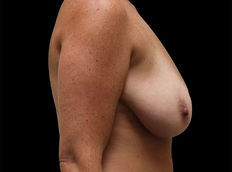 Breast Reduction Before & After Patient #2754