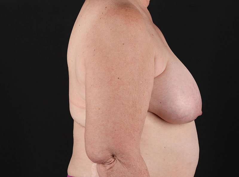 Breast Reduction Before & After Patient #2766