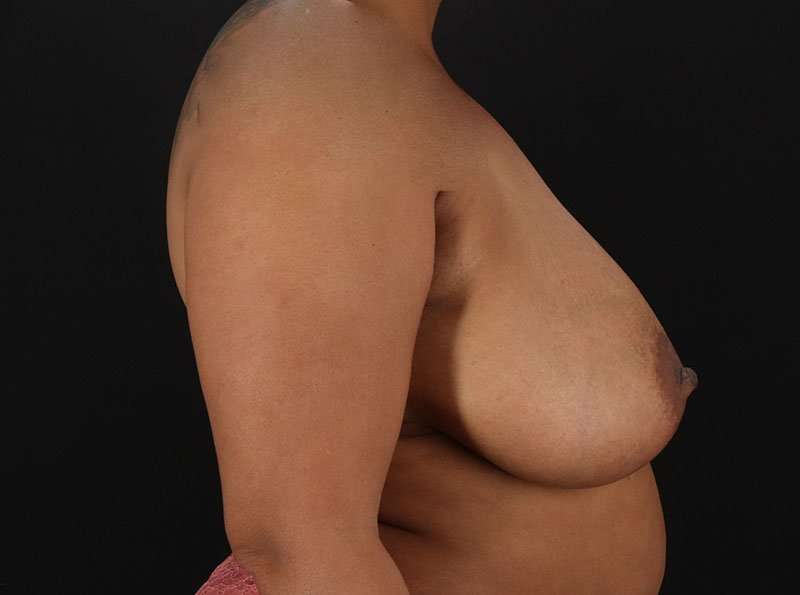 Breast Reduction Before & After Patient #2777