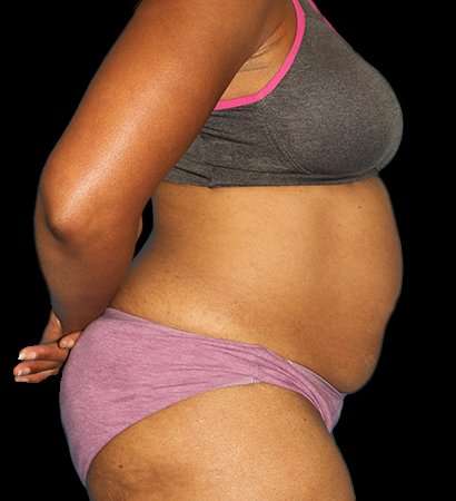 Abdominoplasty (Tummy Tuck) Before & After Patient #790