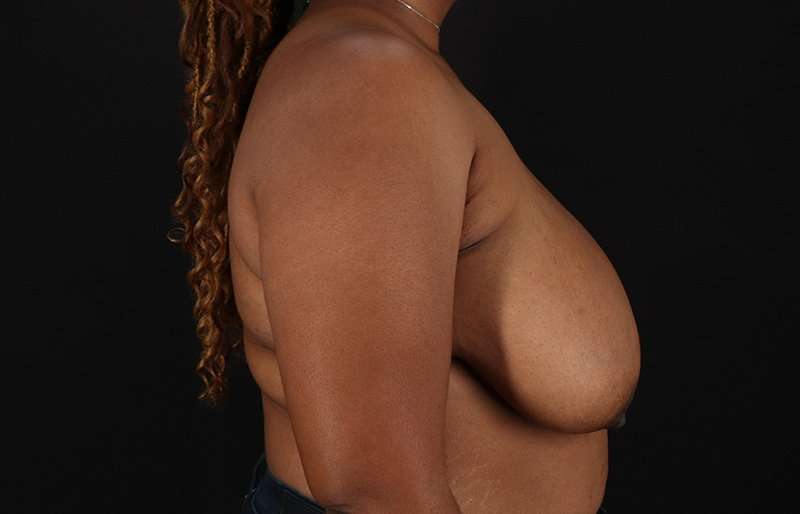 Breast Reduction Before & After Patient #2824