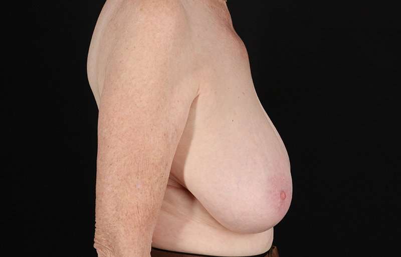 Breast Reduction Before & After Patient #2836
