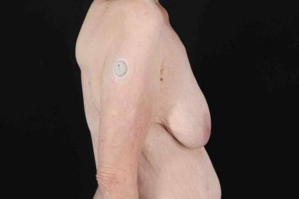 Breast Reduction Before & After Patient #2847