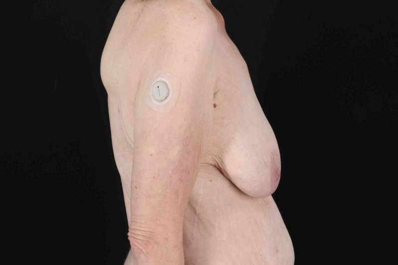 Breast Reduction Before & After Patient #2847