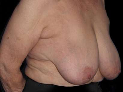 Breast Reduction Before & After Patient #2859