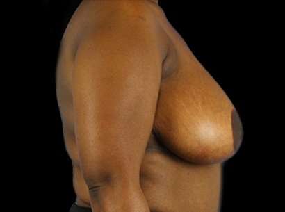 Breast Reduction Before & After Patient #2870