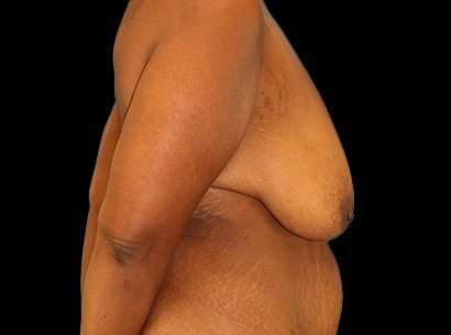 Breast Reduction Before & After Patient #2881
