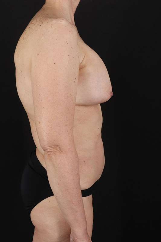 All Me Augmentation Before & After Patient #2914
